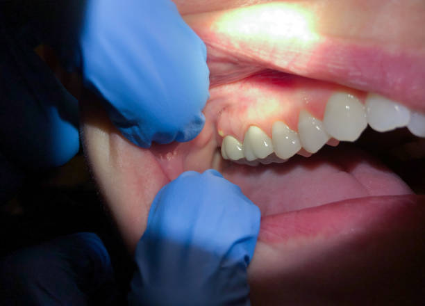Best Emergency Treatment for Oral Infections in Chenango Bridge, NY